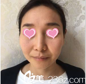 韩国SoonPlus医院金顺东鼻部整形案例术前照 韩国SoonPlus医院金顺东鼻部整形案例术前照