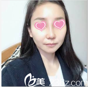 韩国SoonPlus医院金顺东鼻部整形案例术后15天样子 韩国SoonPlus医院金顺东鼻部整形案例术后15天样子