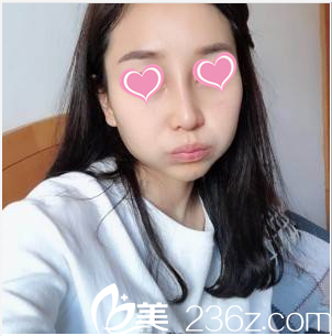 韩国SoonPlus整形医院鼻综合案例术后23天效果 韩国SoonPlus整形医院鼻综合案例术后23天效果