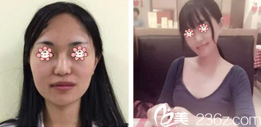 李喆远院长下颌角缩小案例 李喆远院长下颌角缩小案例