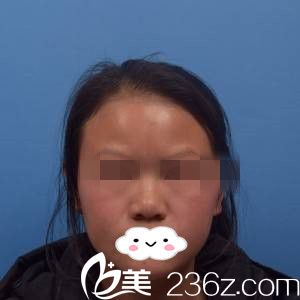 手术前的我 手术前的我