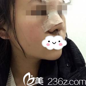 术后第二天 术后第二天