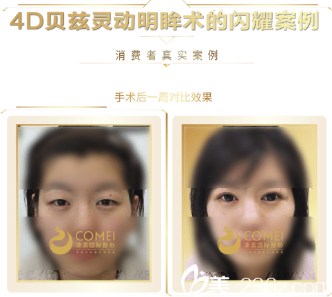 张悦迪医生双眼皮案例