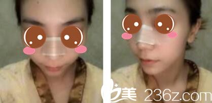 上海新极点医疗美容诊所金炳键假体隆鼻真人案例术后第五天