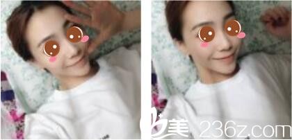 上海新极点医疗美容诊所金炳键假体隆鼻真人案例术后一个月