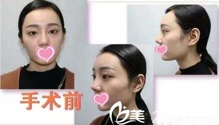 手术前照片 手术前照片