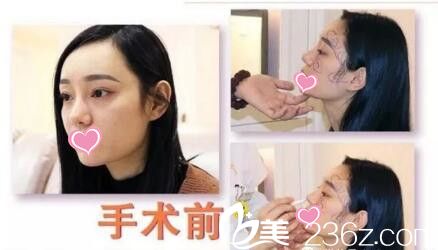 陈院长术前面诊设计画线 陈院长术前面诊设计画线