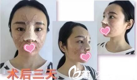自体软骨隆鼻第三天 自体软骨隆鼻第三天