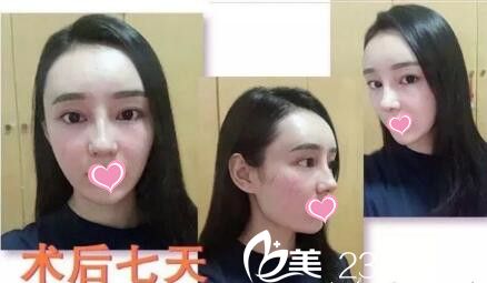 面部脂肪填充+自体软骨隆鼻第7天 面部脂肪填充+自体软骨隆鼻第7天