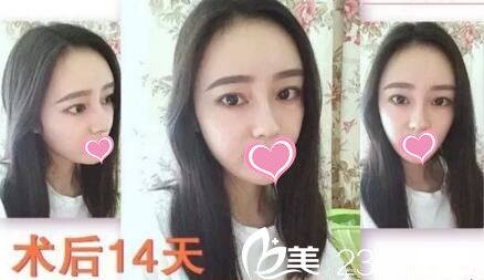 鼻整形+面部脂肪填充术后14天 鼻整形+面部脂肪填充术后14天