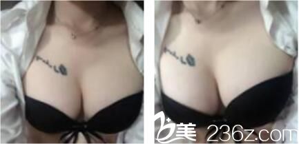 想做假体隆胸较后听了上海新极点朴一鸿院长的话做了自体脂肪隆胸，现在三个月过去了恢复的越来越好