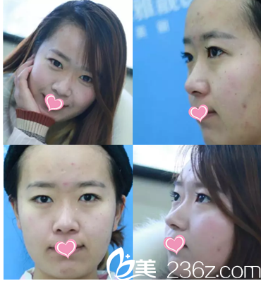 北京雅靓切开双眼皮鼻综合案例 北京雅靓切开双眼皮鼻综合案例