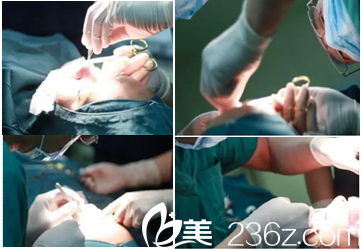 北京雅靓切开双眼皮鼻综合案例手术中 北京雅靓切开双眼皮鼻综合案例手术中