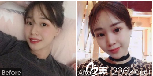 深圳美加美陈群院长切开双眼皮案例图 深圳美加美陈群院长切开双眼皮案例图