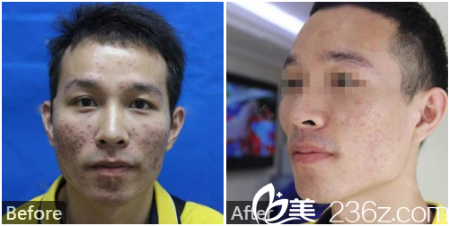 深圳美加美整形医院李莉点阵激光祛痘案例 深圳美加美整形医院李莉点阵激光祛痘案例