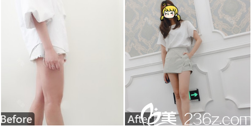 深圳美加美陈群医生大腿吸脂案例图 深圳美加美陈群医生大腿吸脂案例图
