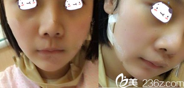 安徽合肥红妆（亚典）面部吸脂+去颊脂垫第3天恢复情况