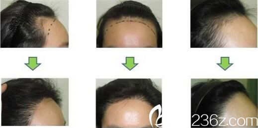 毛发移植真人前后对比