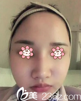 <!--<i data=20240703-sp></i>-->凤医生给我术后4天 <!--<i data=20240703-sp></i>-->凤医生给我术后4天