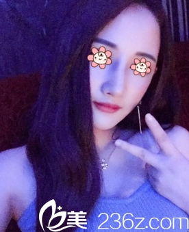 新疆黎美整形下颌角+颧弓内推术后38天 新疆黎美整形下颌角+颧弓内推术后38天