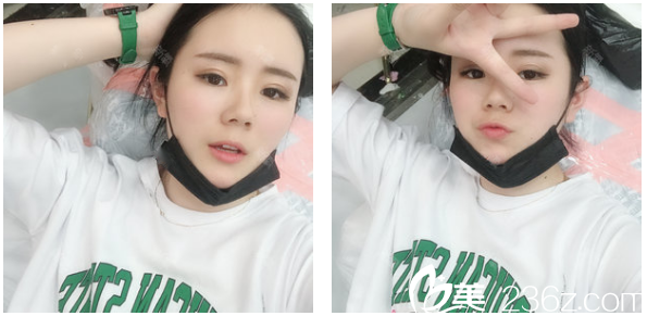 广州美莱张毓医生做的自体脂肪面部填充全脸案例术后一个月图片