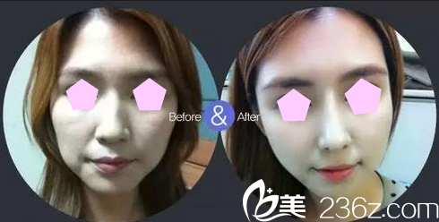 大同美神面部线雕术前术后效果对比图