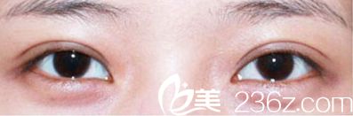 看我在白山凤凰做的韩式双眼皮术后效果真的让眼睛自然变大