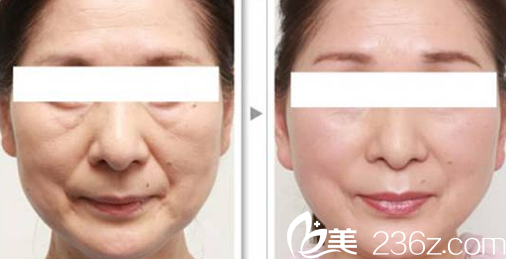 大同美神面部线雕前后效果对比图