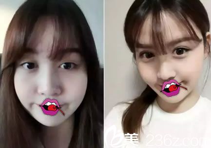 义乌阳光双眼皮修复<span style= 义乌阳光双眼皮修复<span style=