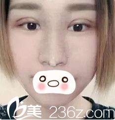 术后三天眼鼻整形恢复