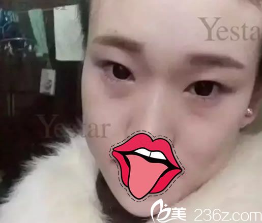 在嘉兴艺星做双眼皮手术前 在嘉兴艺星做双眼皮手术前