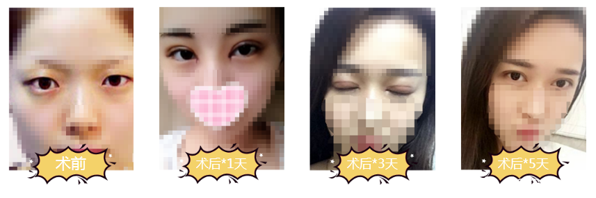 苏州美贝尔双眼皮整形案例