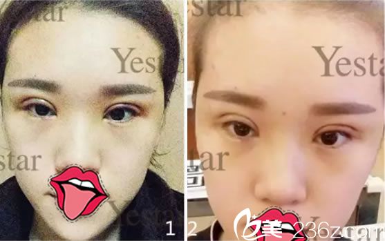 做完双眼皮和祛皮祛脂术后3天 做完双眼皮和祛皮祛脂术后3天