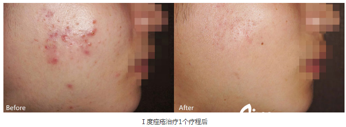 苏州美贝尔激光祛痘案例