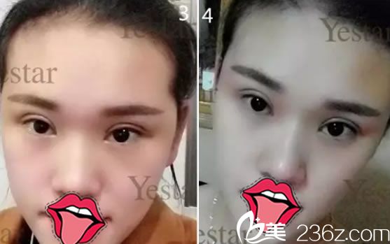 在嘉兴艺星做双眼皮7天恢复效果 在嘉兴艺星做双眼皮7天恢复效果