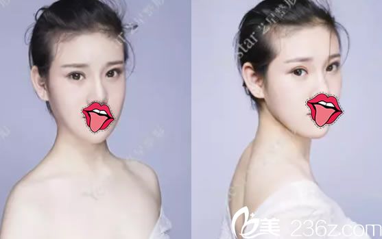 贴了两年的双眼皮贴后到嘉兴yestar艺兴整形找储刚主任做了双眼皮开眼角手术和玻尿酸填充太阳穴