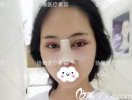 眼鼻手术后即刻术后效果