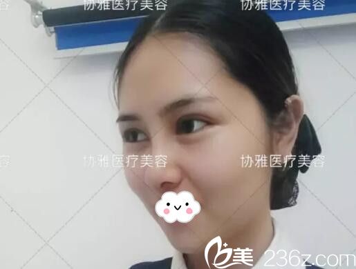 在协雅做眼鼻整形手术半个月效果