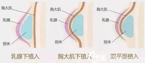 隆胸一般价格多少?南宁伊丽莎白蜜桃丰胸43000元起让你从此乳沟不用挤