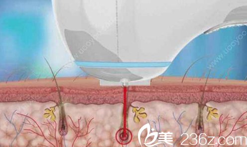 辽源澎涛激光脱毛的原理 辽源澎涛激光脱毛的原理
