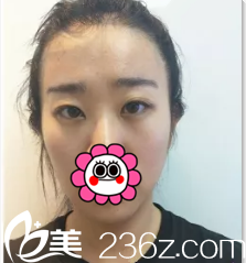 北京清木切开双眼皮+开眼角案例术前照 北京清木切开双眼皮+开眼角案例术前照