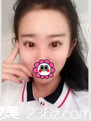 北京清木双眼皮案例术后35天效果 北京清木双眼皮案例术后35天效果