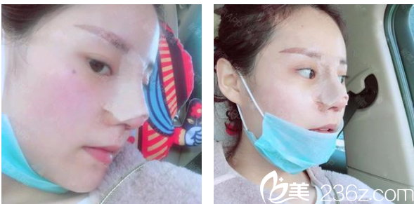 <!--<i data=20240703-sp></i>-->整形医院罗志敏隆鼻子术后第五天 <!--<i data=20240703-sp></i>-->整形医院罗志敏隆鼻子术后第五天