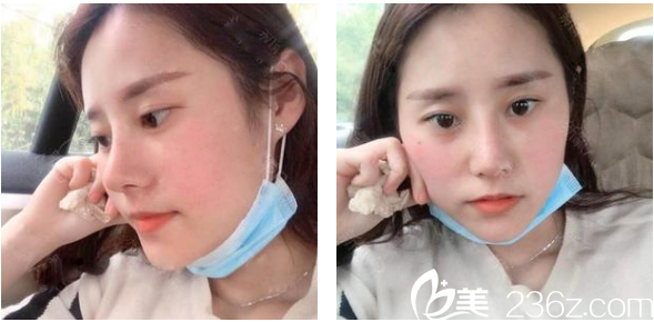 <!--<i data=20240703-sp></i>-->整形医院罗志敏做的鼻综合隆鼻术后半个月图片 <!--<i data=20240703-sp></i>-->整形医院罗志敏做的鼻综合隆鼻术后半个月图片