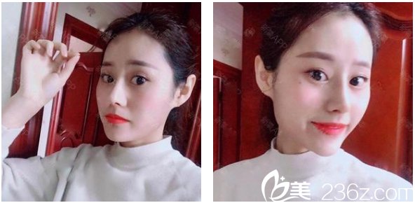 找<!--<i data=20240703-sp></i>-->整形医院罗志敏做的鼻综合隆鼻子术后一个月恢复情况 找<!--<i data=20240703-sp></i>-->整形医院罗志敏做的鼻综合隆鼻子术后一个月恢复情况