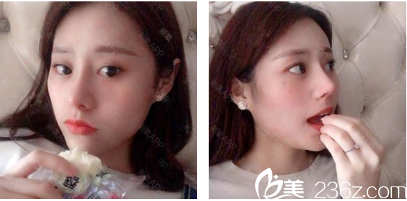 <!--<i data=20240703-sp></i>-->整形医院罗志敏鼻综合隆鼻子案例术后两个月效果图 <!--<i data=20240703-sp></i>-->整形医院罗志敏鼻综合隆鼻子案例术后两个月效果图