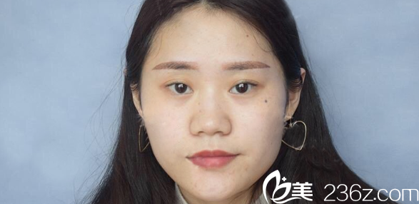 术前塌鼻子照片 术前塌鼻子照片