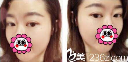 韩国名品整形外科医院李灿韩式双眼皮真人案例术后第七天