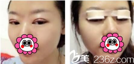 韩国名品整形外科医院李灿韩式双眼皮真人案例术后第三天