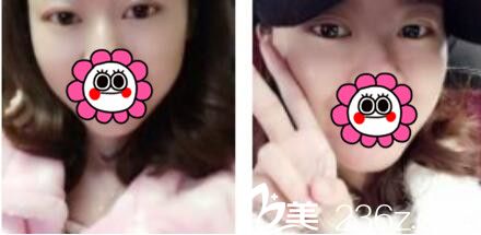 韩国名品整形外科医院李灿韩式双眼皮真人案例术后十五天